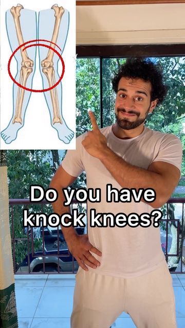 Knock Knees Exercises, Knee Pain Remedies, Knock Knees, Leg Workout Routine, Knee Pain Exercises, Yoga Beginners, Quick Workout Routine, Abs And Cardio Workout, Knee Exercises