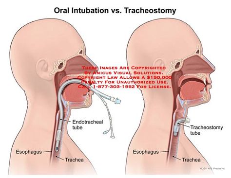 Endotracheal tube: inserted through the nares or the mouth past the epiglottis and vocal cords into trachea. A tracheostomy tube is inserted directly into trachea through a small incision made in pt's neck. Anesthesia Notes, Respiratory Nursing, Endotracheal Tube, Nursing Informatics, Nurse Bae, Nurse Education, Medical Slp, Nursing Instructor, Vocal Cords