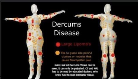 Dercums Disease, Manual Lymph Drainage, Genetic Diseases, Lymph Drainage, Rare Disease, Adrenal Fatigue, Invisible Illness, Chronic Fatigue, Autoimmune Disease