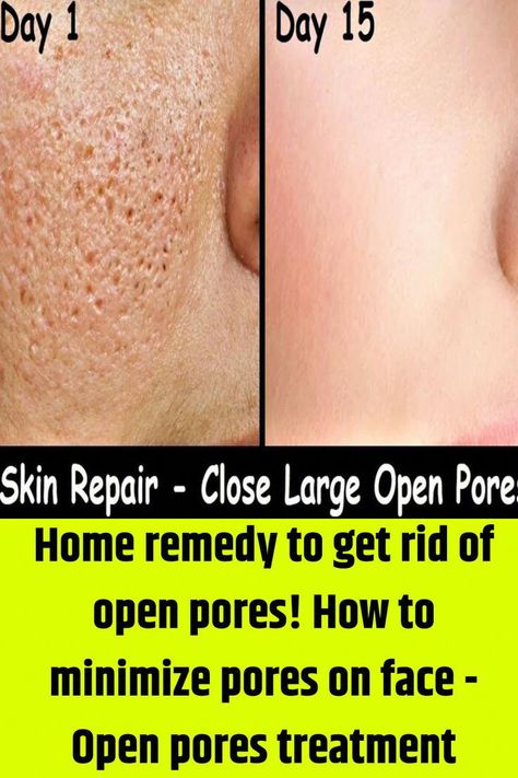 #BestWayToRemoveUnwantedHair Remedies For Pores On Face, Big Pores On Face Remedies, Facial Pores Remedies, Get Rid Of Big Pores On Face, Face Pores Remedies, How To Treat Open Pores On Face, Reduce Open Pores On Face, How To Minimize Pores Naturally, Remedies For Open Pores On Face