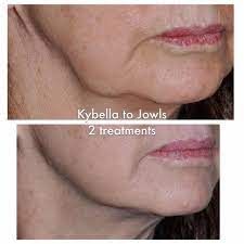 Kybella Delaware Rehoboth Michelle Parsons, MD Double Chin Reduction, Thyroid Surgery, Double Chin Removal, Dental Infection, Pectoral Muscles, Facial Plastic Surgery, Cosmetic Dermatology, Under The Knife, Firming Serum