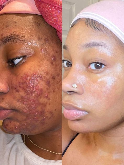 Does your skin look like this or similar, have you been trying useless products that don't work for your skin, you NEED to use SKINBYLIN. Our products will give you life changing results FAST !! 📌 eye wrinkle cream, facial moisturizer, skin treatments for dark spots ✨ #inspiration #sulfatefree #rosacea Skin Treatments For Dark Spots, Glowing Black Skin, Skin Care Hyperpigmentation, Skin Anatomy, Eye Wrinkle Cream, Top Anti Aging Products, Wrinkle Remedies, Skin Lightener, Celebrity Plastic Surgery