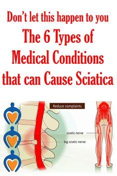 Nerve Exercises, Sciatic Nerve Relief, Sciatic Nerve Pain Relief, Nerve Problems, Sciatica Stretches, Sciatica Symptoms, Piriformis Stretch, Sciatica Exercises, Piriformis Syndrome