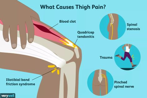 Femoral Nerve, Calf Cramps, Nerve Pain Relief, Thigh Muscles, Sciatic Nerve Pain, Knee Pain Relief, Neck And Back Pain, Sciatic Nerve, Leg Pain