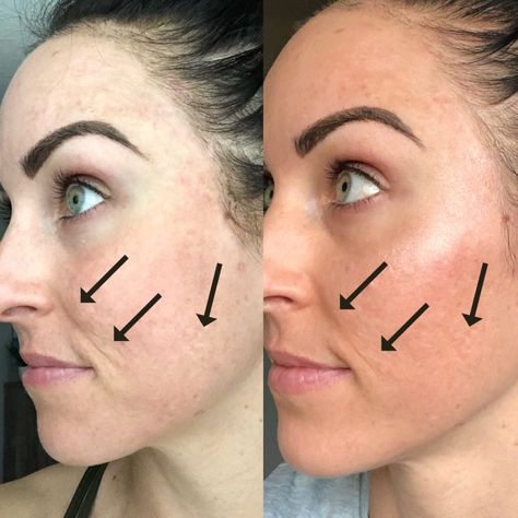 Post Microneedling Care, Dr Pen Microneedling Before And After, Skin Pen Microneedling, Rejuvapen Microneedling, Microneedling After Care, Microneedling Before And After, At Home Microneedling, Home Microneedling, After Microneedling