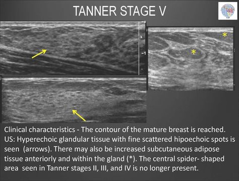 Breast Development - Tanner Stage V Adipose Tissue