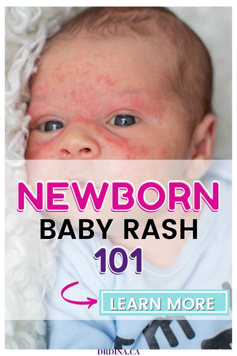 Parents often seek advice about rashes or skin changes their babies are born with or develop in the first few weeks or months of life. Rashes commonly cause stress for parents, as we want our kids to have flawless skin! Here we will review the most common rashes we see in the newborn and young-baby stages. Teething Rash On Face, Face Rash Remedies, Skin Rash On Face, Newborn Rash, Newborn Acne, Viral Rash, Baby Rashes, Baby Skin Rash, Rash On Face