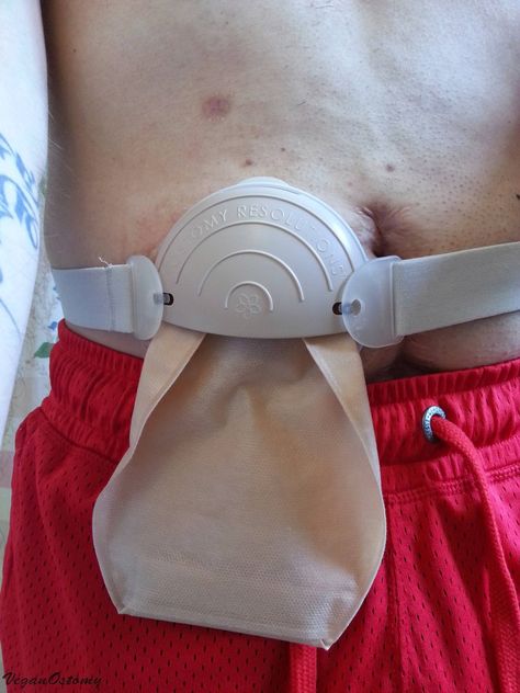 Ostomy Resolutions Stoma Guard – REVIEW Stoma Bag, Ostomy Supplies, Ostomy Care, Ostomy Bag, Accessories Guide, Clothing Guide, Bag Cover, Reflexology, Simple Bags