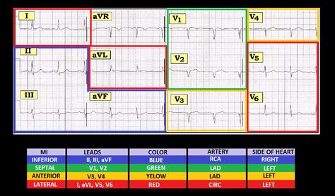 Location of MI Cardiac Notes, Qt Interval, Paramedic Student, St Elevation, Pr Interval, Paramedic School, Parts Of The Heart, Study Flashcards, Nursing Notes