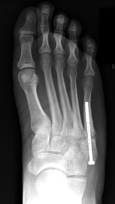 Types of 5th Metatarsal Fractures Broken Bones Humor, Jones Fracture, Metatarsal Fracture, Dance Anatomy, Heal Broken Bones, Bone Anatomy, Fracture Healing, Ankle Ligaments, Knee Scooter