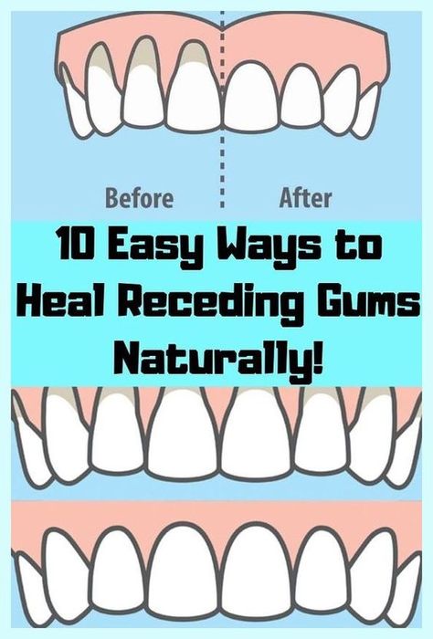 Tremendous details Ways To Heal, Natural Remedies For Allergies, Gum Recession, Natural Headache Remedies, Teeth Health, Periodontal Disease, Receding Gums, Hygiene Routine, Dental Problems