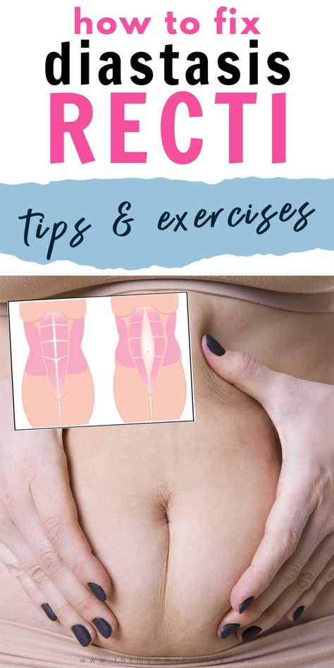 Separated Stomach Muscles, Exercises For Separated Abdominal Muscles, Ab Repair Diastasis Recti, Abdominal Separation Diastasis Recti, Oblique Exercises For Diastasis Recti, Exercises For Abdominal Separation, Muscle Separation Exercises, An Separation Exercises, Exercises To Fix Diastasis Recti