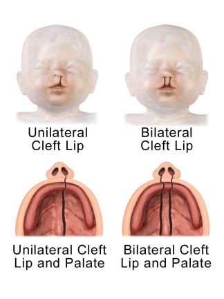 Unilateral_and_Bilateral_Cleft_Lip_and_Palate Cleft Lip And Palate Awareness, Obstetrics Nursing, Cleft Lip And Palate, Cleft Palate, Comparative Analysis, Cleft Lip, Lip Drawing, Aesthetic Medicine, Lips Drawing