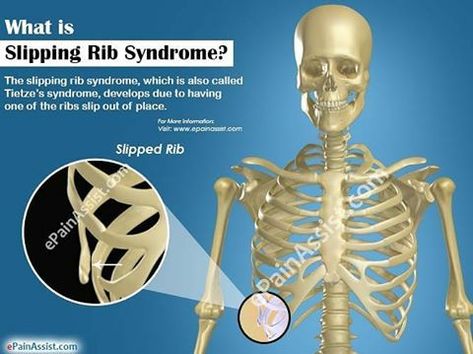 Sore Joints Remedies, Postural Assessment, Slipping Rib Syndrome, Dislocated Rib, Ehlers Danlos Syndrome Hypermobility, Human Rib Cage, Rib Pain, Chiari Malformation, Yoga Anatomy