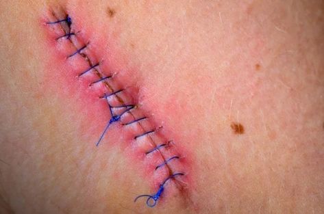 Medical Stitches, Stitches Medical, Mole Removal, Wound Dressing, Types Of Stitches, Wound Care, After Surgery, Wound Healing, Skin Healing