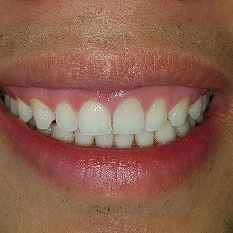 12mm vertical band of tissue in the upper vestibule is removed extending horizontally from midline to the corner of the smile using a #12 blade. Measure twice. Use intraoral marking pen for outline. How To Whiten Dentures, How To Clean Dentures, How To Whiten Clothes, Natural Disinfectant, Gummy Smile, Dentures, Upper Lip, Natural Teeth, Natural Cleaners