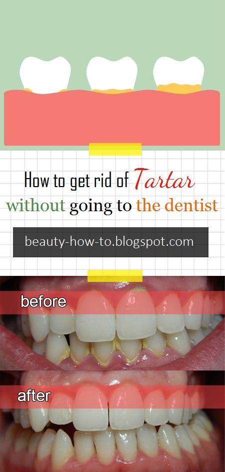 How to get rid of tartar without going to the dentist Toddler Tooth Decay, Going To The Dentist, Tartar Removal, Coconut Oil For Teeth, Skin Tags, Healthy Food Facts, Hygiene Care, Stronger Teeth, Oral Care Routine