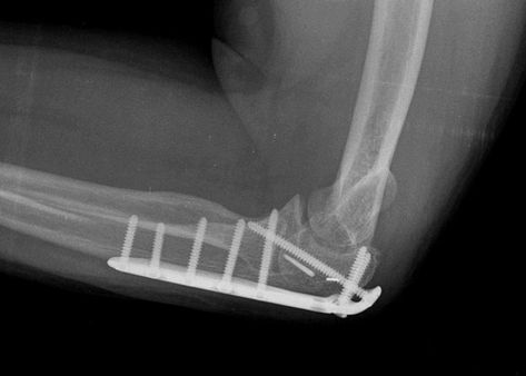 Elbow Fractures Types Of Fractures, Ligament Injury, Energy Transfer, Ct Scan, Medical History, Problem And Solution, Medical Care, Medical Conditions, Surgery