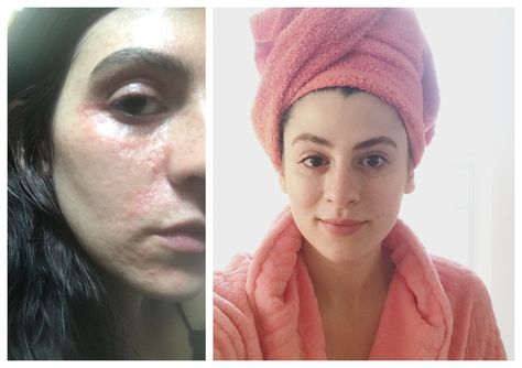 How "Skin Fasting" Helped Clear My Complexion In Just One Week Clear Complexion Tips, Skin Fasting, Skin Regimen, Skin Detox, My Hobby, Healthy Glowing Skin, Skin Care Steps, Skin Cleanse, Moisturizing Serum