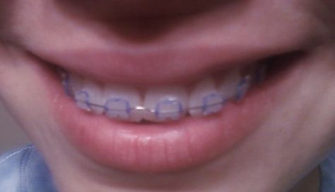 metalic silver braces #color #ties Ceramic Braces Color Bands, Lilac Braces, Ceramic Braces With Colored Bands, Purple Power Chain Braces, Clear Braces With Color Bands, Dark Blue Power Chain Braces, Light Blue Power Chain Braces, Silver Braces, Dental Braces Colors