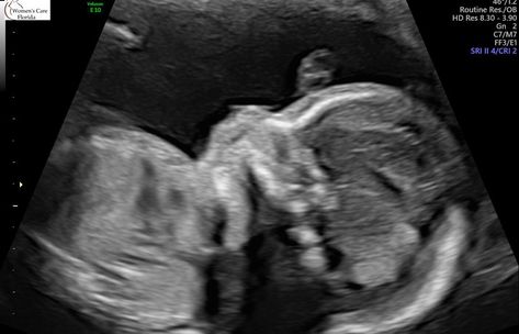 My Pregnancy-The 20 Week Detailed Anatomy Scan #advancedmaternalage #pregancy #20weekspregnant #tiffanydbrown #ultrasound 20 Week Ultrasound Pictures, 20 Week Ultrasound, 3d Ultrasound Pictures, Boy Ultrasound, Twins Ultrasound, 20 Week Scan, Baby Ultrasound Pictures, 21 Weeks Pregnant, 3d Ultrasound