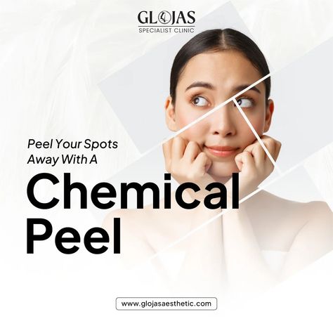 𝗔𝗲𝘀𝘁𝗵𝗲𝘁𝗶𝗰 𝗖𝗹𝗶𝗻𝗶𝗰 𝗞𝘂𝗮𝗹𝗮 𝗟𝘂𝗺𝗽𝘂𝗿 | Chemical Peel: Reveal Your Skin's True Radiance A chemical peel can help you achieve smoother, younger-looking skin. This minimally invasive procedure removes the top layers of skin, revealing a fresh, rejuvenated complexion. Benefits of a Chemical Peel: • Reduced fine lines and wrinkles • Minimized acne scars • Improved skin texture and tone • Faded age spots and sun damage #aestheticclinickualalumpur #chemicalpeel #aestheticclinicmalaysia #aestheticsclini... Aesthetic Clinic, Textures And Tones, Chemical Peel, Layers Of Skin, Younger Looking Skin, Sun Damage, Age Spots, Fine Lines And Wrinkles, Skin Texture