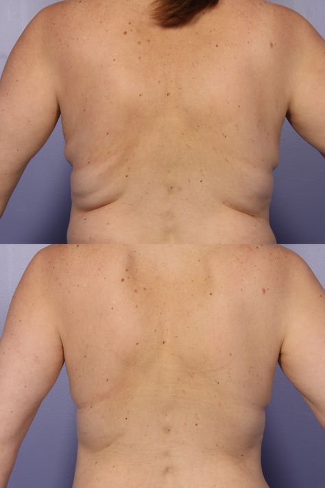 Coolsculpting Before And After, Fat Freezing, Laser Surgery, Cosmetic Dermatology, Cool Sculpting, Chevy Chase, After Pictures, Men's Health, Organic Health