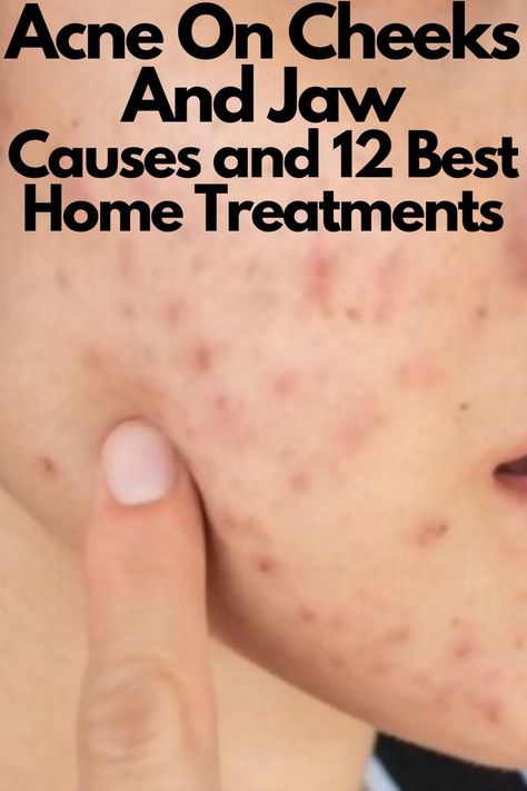 Acne On Cheeks And Jaw - Causes and 12 Best Home Treatments Cheek Acne Cause, Acne On Cheeks, Nodule Acne, Jawline Acne, Cheek Acne, Acne Men, Chin Acne, Skincare For Combination Skin, Pimples Remedies