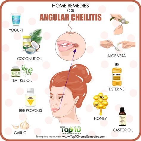 Lip Remedies, Cracked Corners Of Mouth, Lips Cracked, Angular Cheilitis, Chapped Lips Remedy, Character Customization, Top 10 Home Remedies, Hippie Living, Oil Remedies