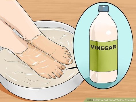 fungal nail pedicure Brittle Toenails, Clean Toenails, Yellow Toenails, Yellow Toe Nails, Toenail Fungal Infection, Remove Yellow Stains, Nail Remedies, Nail Discoloration, Nail Infection