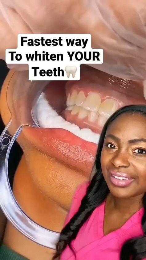 Fastest Way to whiten your Teeth  CC-@avaleneR #FitLife #FitnessTips #HealthTips #HealthyLiving #NutritionTips #HealthyLifestyle #Wellness #SelfCare How To Whiten Teeth, Teeth Hacks, Baby Bottle Tooth Decay, Teeth Whitening Procedure, Best Mouthwash, Braces Tips, Tooth Decay Remedies, Blackhead Remedies, Whiten Your Teeth