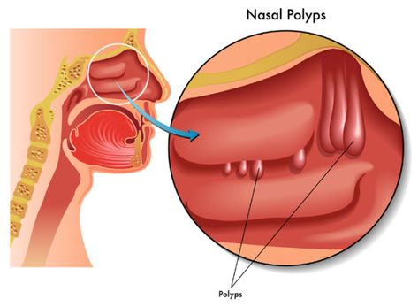 Sinus Polyps, Remedy For Sinus Congestion, Nasal Polyps, Paranasal Sinuses, Home Remedies For Sinus, Chronic Sinusitis, Allergic Rhinitis, Sinus Congestion, Nasal Congestion