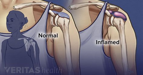 Shoulder bursitis occurs when the bursa in the shoulder becomes inflamed. Shoulder bursitis is closely associated with a condition called shoulder impingement syndrome (sometimes called subacromial pain syndrome). Subacromial Bursitis, Shoulder Bursitis, Bursitis Elbow, Bursitis Shoulder, Shoulder Pain Exercises, Shoulder Problem, Rotator Cuff Tear, Shoulder Impingement, Bicep Muscle