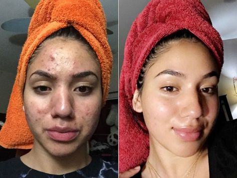 Teen who suffered severe acne shares miracle routine which cleared her skin – using just four budget products, including Dr. Bronner's Castile Soap. Pele Natural, Severe Acne, Natural Acne, Acne Remedies, Jason Statham, Girl Tips, Acne Skin, Crochet Hair, Skin Care Acne