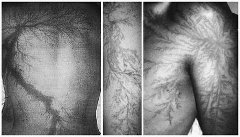 Lightning Struck Scars, Lichtenberg Scars, Lightning Scar Reference, Lightning Strike Scar, Lichtenberg Scar, Lightning Scar Drawing, Struck By Lightning Scar, How To Draw Burn Scars, Burn Reference