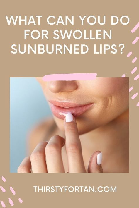 Lip Blister Remedy, Swollen Lip Remedy, Sun Blisters, Best For Sunburn, Sunburnt Lips, Sunburn Blisters, Sunburned Lips, Blister On Lip, Swollen Lips