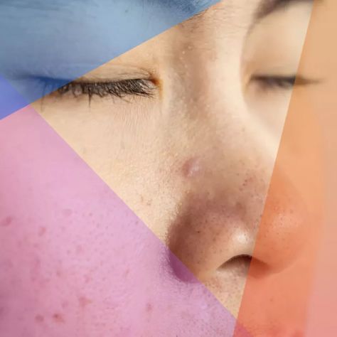 Sometimes, bumps inside of the nose may not actually be acne, but other skin conditions. In order to get rid of acne breakouts, you’ll need to rule out some common conditions that may affect the interior of the nose. Pimple Inside Nose, Nose Pimples, Treating Cystic Acne, Chin Acne, Get Rid Of Pimples, Rid Of Pimples, Cleanser For Oily Skin, Acne Vulgaris, Scaly Skin