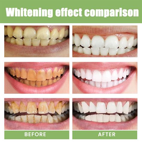 5 Day Teeth Whitening Powder Remove Plaque Stains Toothpaste Deep Cleaning Fresh Breath Oral Hygiene Dentally Tools Teeth Care https://s.click.aliexpress.com/e/_DCB6KLf #removeplaque #oralhygiene #teethwhitening #teethcare #stains Tooth Gel, Tooth Whitening, Dental Plaque, Tooth Powder, Yellow Teeth, Stained Teeth, Dental Tools, Whitening Toothpaste, Teeth Care