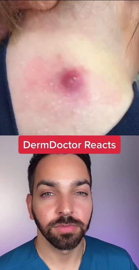 Armpit Pimples, Satisfying Pore Cleaning Videos, Huge Pimple Poppìng, Satisfying Videos Popping Pimples, Pore Vacuum Videos, Cystic Acne Removal Video, Oddly Satisfying Videos Blackheads, Armpit Boil, Zit Popping