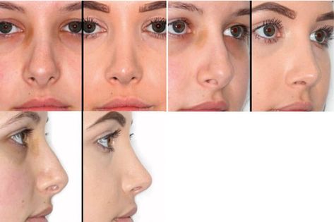 The tip in rhinoplasty | ENT & Audiology News Tip Rhinoplasty, Tall Nose, Calvin Johnson, Facial Fillers, Facial Plastic Surgery, Nose Shapes, Facial Plastic, Tall People, Short People