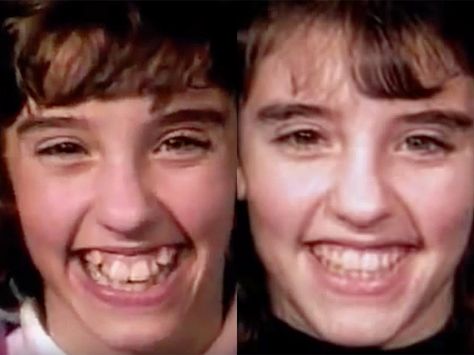 This mesmerizing time lapse shows how braces straighten even the most crooked teeth - The INSIDER Summary:  An old time lapse of braces straightening crooked teeth just resurfaced on Reddit.  It shows braces transforming the teeth of an 11-year-old girl over the course of 18 months.  It's mesmerizing to watch.  We all know that braces can straighten teeth, but it's tough to notice those subtle shifts in alignment as they happen in real time. That's why watching time lapses of braces at work is s Straighten Teeth, Crooked Teeth, American Dental Association, Dental Braces, Teeth Straightening, Teeth Braces, Tupac, Time Lapse, Braces