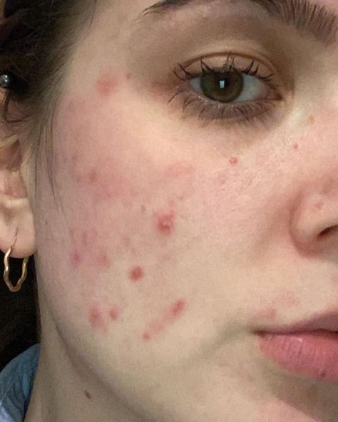 Diana’s Instagram profile post: “Anyone else having even more breakouts due to face masks? Need to try and find better materials😭 #acne #maskcne #maskne #spots #breakout…” Breakouts On Face, Growing Confidence, Acne Positivity, Skin Positivity, Regular Skin Care Routine, Marks Cream, Scar Removal Cream, Clean Blackheads, French Skincare