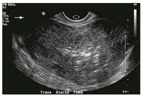 Transvaginal ultrasound of a normal uterus 5 days postpartum. Transverse image shows echogenic foci in the endometrial cavity, which may be a normal finding in a postpartum patient. Uterus Ultrasound, Cystic Ovaries, Ultrasound Pictures, Bts V Pictures, Chroma Key, Ultrasound, Bts, Education, Quick Saves