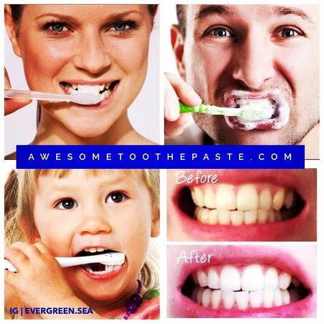 Teeth Whitening Procedure, Whitening Strips, Teeth Whitening Remedies, Dental Cavities, Charcoal Teeth Whitening, Pasta Dental, Whiten Teeth, Yellow Teeth, Natural Teeth Whitening