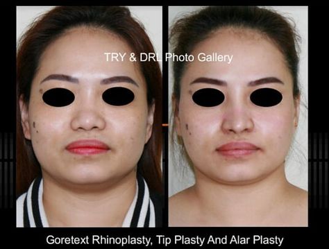 https://flic.kr/p/2h2TDEG | Instagram : Before And After Goretex Rhinoplasty with Tip Plasty and Alar Plasty | Check out our new Before And After Goretex Rhinoplasty with Tip Plasty and Alar Plasty_Female Profile here: www.instagram.com/p/B1aTcyaHNvM/ For more before and after photos check out their Instagram page @ www.instagram.com/rino_lorenzo_md/ Tip Plasty, Rhinoplasty Before And After, Female Profile, After Photos, Instagram Page, Gore Tex, Carnival Face Paint, Sleep Eye Mask, Halloween Face Makeup