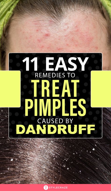 How To Prevent Pimples Due To Dandruff How To Treat Pimples, Pimples On Scalp, Pimple Causes, Dandruff Causes, Remove Skin Tags Naturally, Dandruff Remedy, Pimples Remedies, Prevent Pimples, Aloe Vera Face Mask