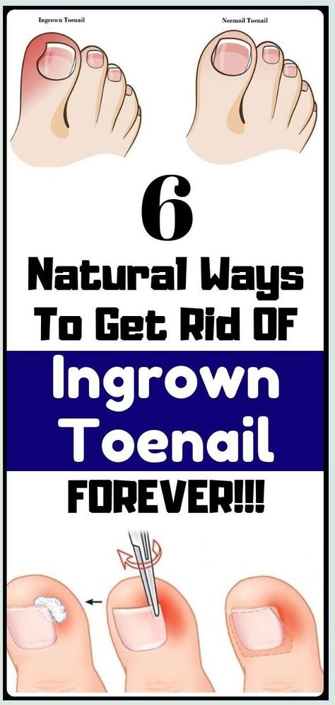 Foot Nail Problems Nail Fungus Remedy, Ingrown Toenail, Healing Remedies, Ingrown Nail, Health Hacks, Tongue Health, Health Signs, Ingrown Toe Nail, Healthy Advice