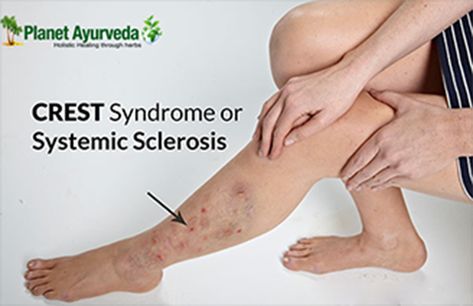 #Scl70 #antibodies (topoisomerase 1) are a 100-kD #nuclear and #nucleolarenzyme which are considered to be specific for #Scleroderma and are found in nearly 60% of patients having this connective tissue disease. Scleroderma Symptoms, Scleroderma Awareness, Essential Tremors, Autoimmune Disorders, Maria Brink, Sjogrens Syndrome, Auto Immune, Stay Alive, Autoimmune Disorder