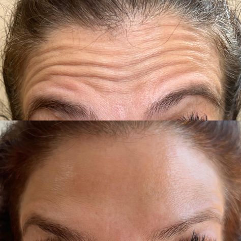 Botox: Confidence in a bottle 🪄 This is forehead and glabellar Botox- it takes about two weeks to kick in and will last 3-4 months. 📍 150-55A 14th Ave Whitestone, NY 11357 🛎️: Sundays, By Appointment ONLY 📱: (718)-374-5081 📧: skinvigoratednyc@gmail.com 👩🏻‍💻Book Online: skinvigoratednyc.com #botox #injector #lipfiller #botox #beauty #aesthetics #injectables #fillers #lips #dermalfillers #filler #juvederm #lipinjections #medspa #injections #skincare #dysport #antiaging #restylane #nursei... Botox Injector, Botox Forehead, Botox Facial, Botox Before And After, Botox Face, Facial Fillers, Injectables Fillers, Forehead Wrinkles, By Appointment Only