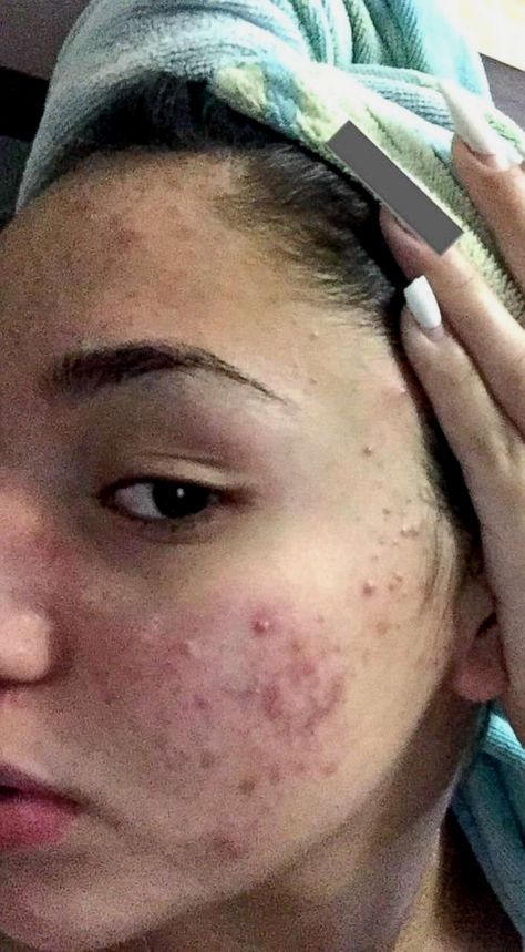 Beautiful Acne, Teenage Acne, Lotion For Oily Skin, Acne Overnight, Pele Natural, Natural Acne Remedies, Desain Editorial, Severe Acne, How To Get Rid Of Pimples